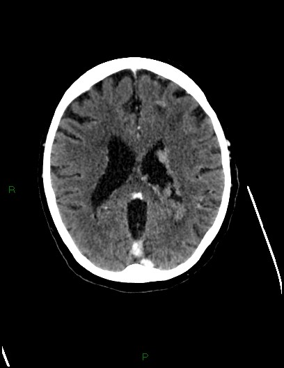 Cerebral metastases - ependymal and parenchymal (Radiopaedia 79877-93131 Axial C+ delayed 50).jpg