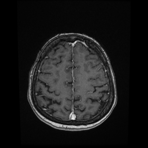 Cerebral metastases - melanoma (Radiopaedia 80972-94522 Axial T1 C+ 73).jpg
