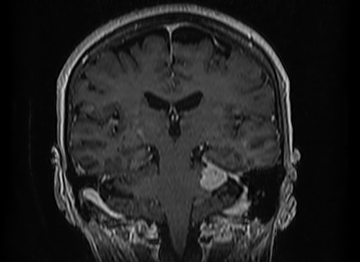 Cerebral metastases from lung cancer with amyloid angiopathy and cerebellopontine angle meningioma (Radiopaedia 74306-85191 Coronal T1 C+ 35).jpg