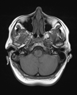 File:Cerebral metastases mimicking abscesses (Radiopaedia 45841-50131 Axial T1 6).png