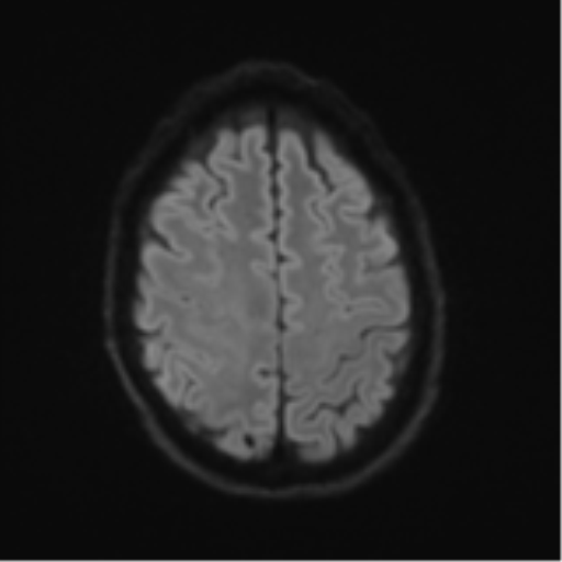 Cerebral metastasis - melanoma (Radiopaedia 54718-60954 Axial DWI 54).png