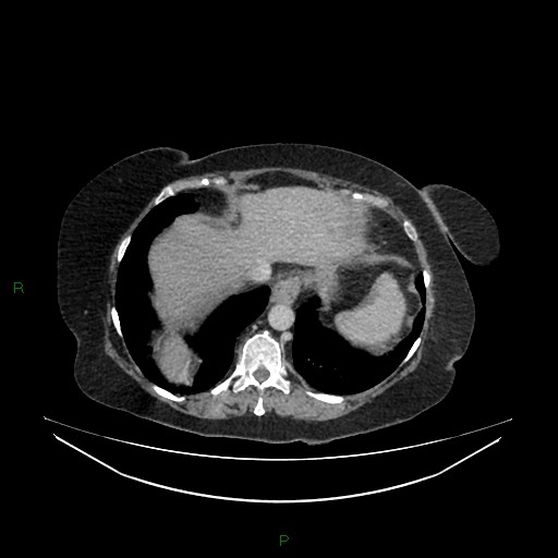 File:Cerebral metastasis from renal cell carcinoma (Radiopaedia 82306-96378 A 22).jpg