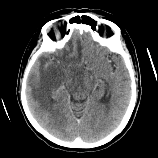 Cerebral metastasis to basal ganglia (Radiopaedia 81568-95412 Axial C+ delayed 26).png
