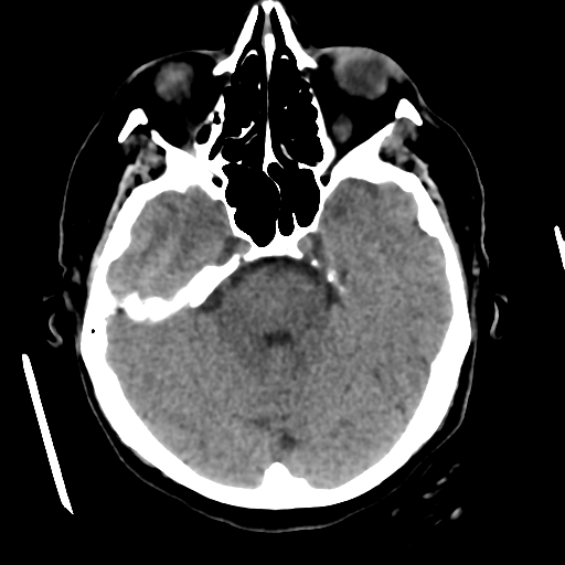 Cerebral metastasis to basal ganglia (Radiopaedia 81568-95412 Axial non-contrast 22).png