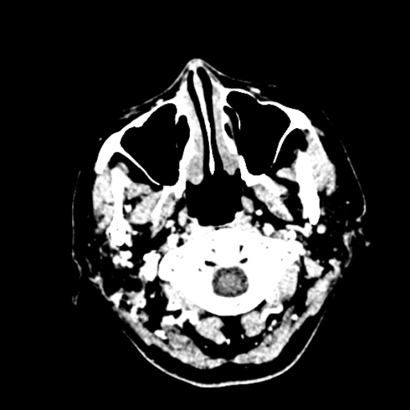 Cerebral ring enhancing lesions - cerebral metastases (Radiopaedia 44922-48818 B 7).jpg