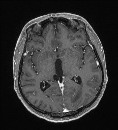 Cerebral toxoplasmosis (Radiopaedia 43956-47461 Axial T1 C+ 35).jpg