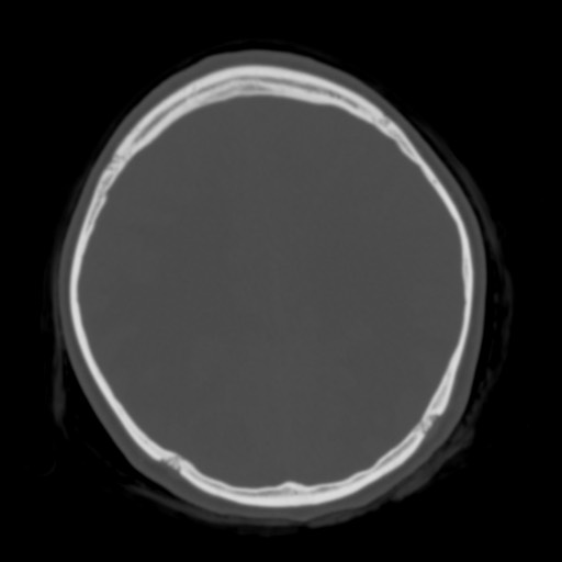 Cerebral tuberculosis with dural sinus invasion (Radiopaedia 60353-68018 Axial bone window 41).jpg
