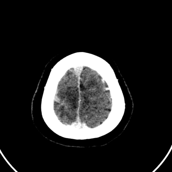 File:Cerebral venous hemorrhagic infarct from venous sinus thrombosis (Radiopaedia 55433-61883 Axial C+ delayed 18).jpg
