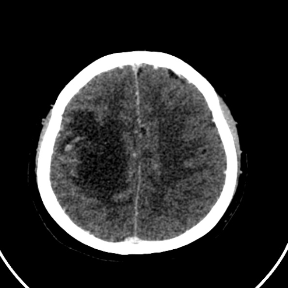 File:Cerebral venous hemorrhagic infarct from venous sinus thrombosis (Radiopaedia 55433-61883 Axial C+ delayed 45).jpg