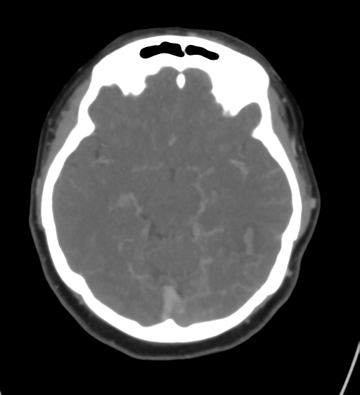 Cerebral venous infarction due to transverse sinus thrombosis (Radiopaedia 34688-36120 Axial CT venogram 22).png