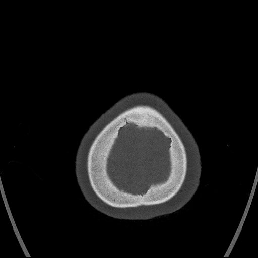 Cerebral venous infarction with hemorrhage (Radiopaedia 65343-74381 Axial bone window 184).jpg