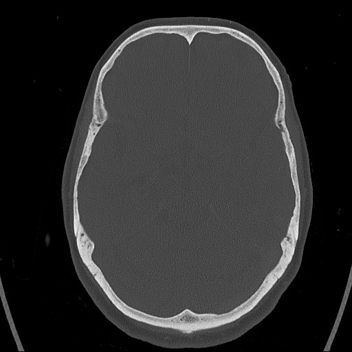 Cerebral venous infarction with hemorrhage (Radiopaedia 65343-74381 Axial bone window 60).jpg
