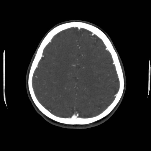 Cerebral venous sinus thrombosis (Radiopaedia 40619-43227 A 174).jpg