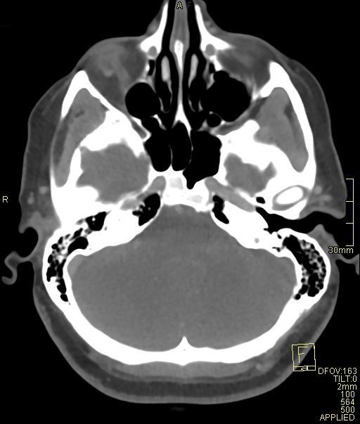 Cerebral venous sinus thrombosis (Radiopaedia 91329-108965 Axial venogram 21).jpg