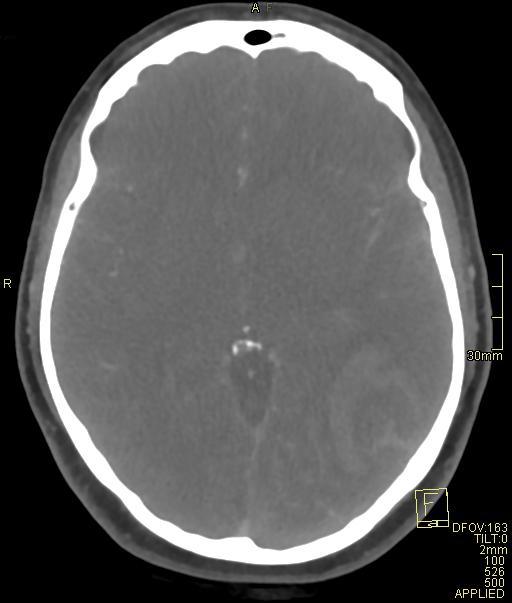 Cerebral venous sinus thrombosis (Radiopaedia 91329-108965 Axial venogram 40).jpg