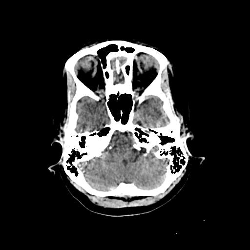 Cerebral venous throbmosis - hemorrhagic venous infarction (Radiopaedia 87318-103613 Axial non-contrast 33).jpg