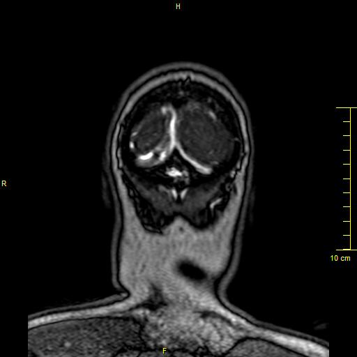 File:Cerebral venous thrombosis (Radiopaedia 23288-23351 MRV 171).JPG