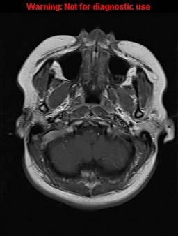 File:Cerebral venous thrombosis (Radiopaedia 37224-39208 Axial T1 C+ 3).jpg