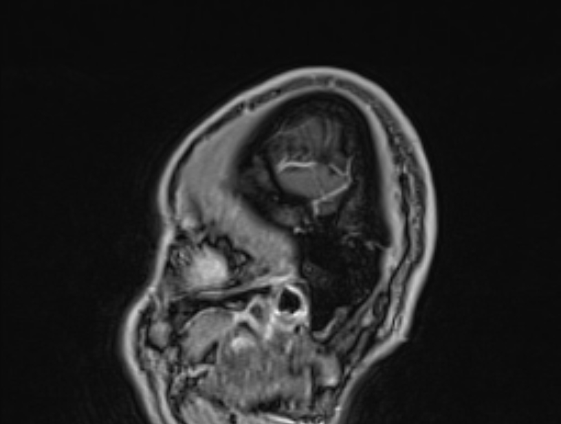 Cerebral venous thrombosis (Radiopaedia 71207-81504 Sagittal T1 C+ 1).jpg