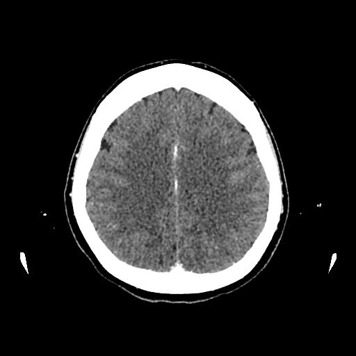 Cerebral venous thrombosis with venous hemorrhagic infarct (Radiopaedia 90354-107660 Axial with contrast 118).jpg