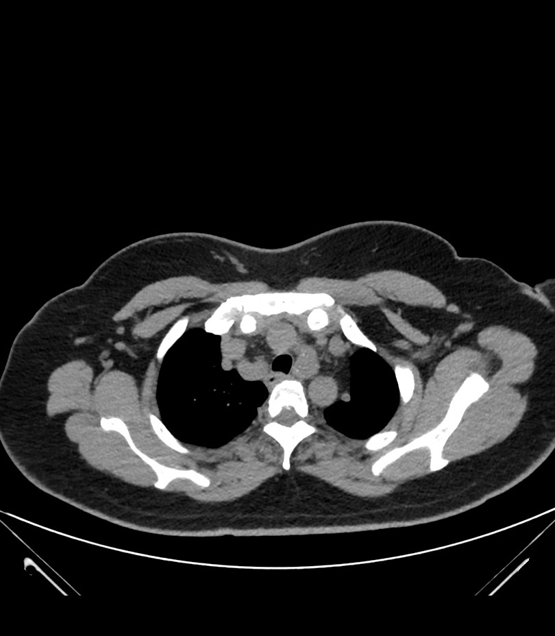 Cervical aortic arch with coarctation and aneurysms (Radiopaedia 44035-47552 Axial non-contrast 14).jpg
