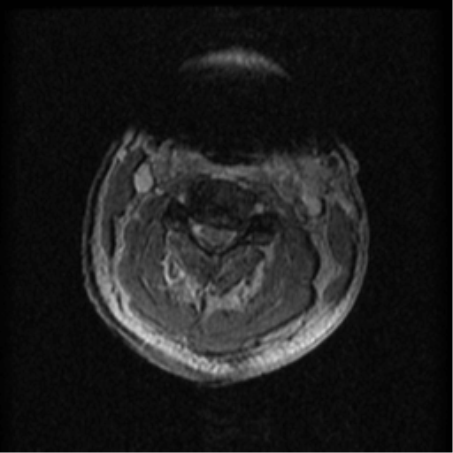 Cervical canal stenosis with cord compression (Radiopaedia 34114-35374 Axial Gradient Echo 65).png