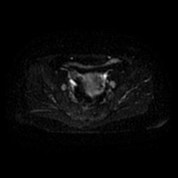 File:Cervical carcinoma (Radiopaedia 67644-77047 Axial DWI 33).jpg