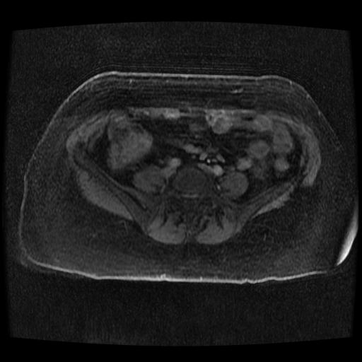 Cervical carcinoma (Radiopaedia 70924-81132 Axial T1 C+ fat sat 172).jpg