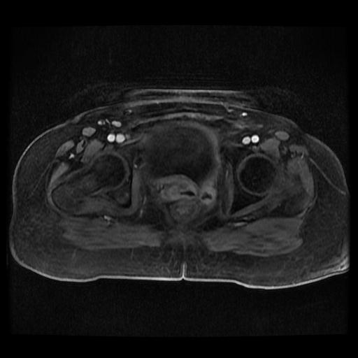 Cervical carcinoma (Radiopaedia 70924-81132 Axial T1 C+ fat sat 214).jpg
