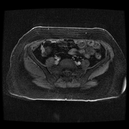 Cervical carcinoma (Radiopaedia 70924-81132 Axial T1 C+ fat sat 253).jpg