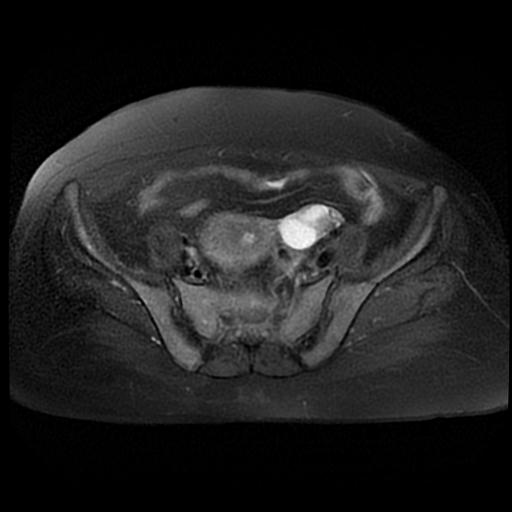 File:Cervical carcinoma (Radiopaedia 88010-104555 Axial T2 fat sat 5).jpg