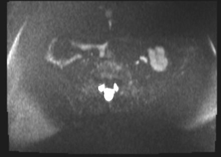 File:Cervical carcinoma (Radiopaedia 88312-104943 Axial DWI 4).jpg