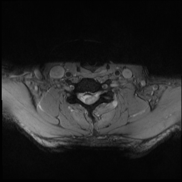 File:Cervical disc extrusion (Radiopaedia 53950-60077 Axial T2 23).jpg