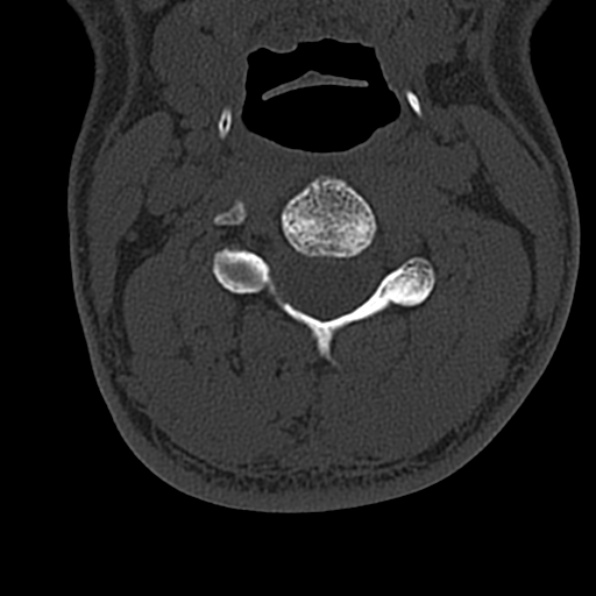 Cervical spondylodiscitis (Radiopaedia 28057-29489 Axial bone window 36).jpg