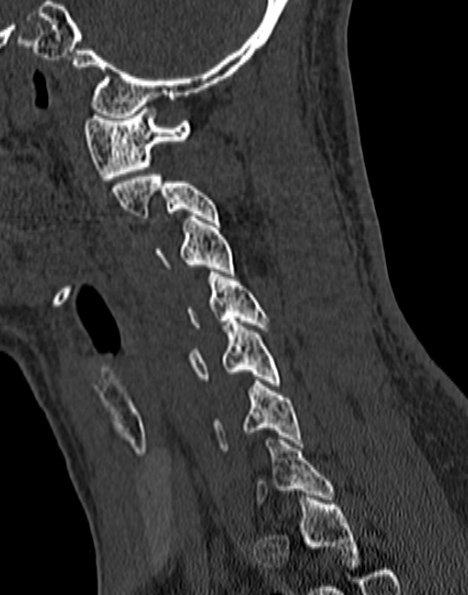 Cervical spondylodiscitis (Radiopaedia 28057-29489 Sagittal bone window 44).jpg
