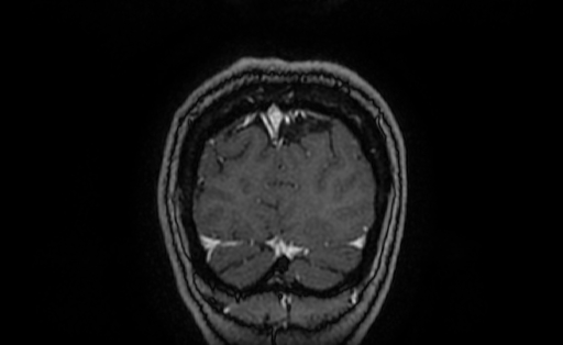 Cervical spondylodiscitis and calvarial hemangioma (Radiopaedia 64317-73103 Coronal T1 C+ 68).jpg