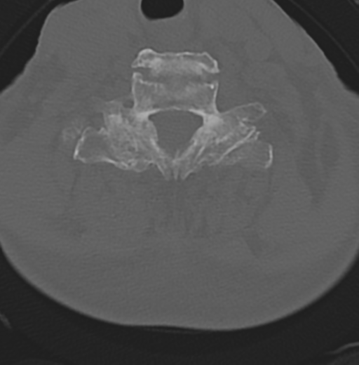 Cervical spondylolysis (Radiopaedia 49616-54811 Axial bone window 41).png
