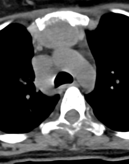 Cervical tuberculous spondylitis (Radiopaedia 39149-41365 Axial non-contrast 62).png
