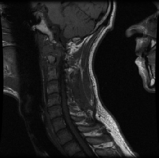 File:Cervical vertebrae metastasis (Radiopaedia 78814-91667 Sagittal T1 8).png
