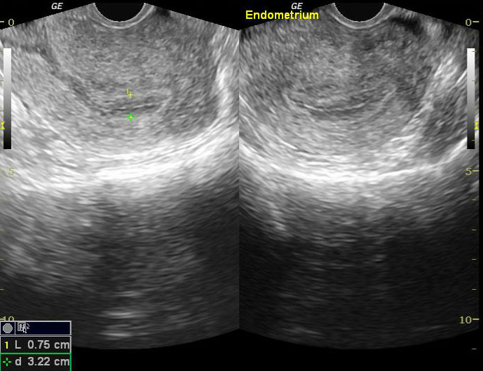 File:Cesarean scar ectopic pregnancy (Radiopaedia 45975).jpg
