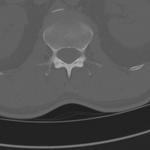 Chance fracture (Radiopaedia 33854-35020 Axial bone window 109).png