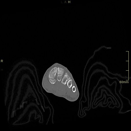 Chaput tubercle fracture (Radiopaedia 80319-93956 Coronal non-contrast 9).jpg