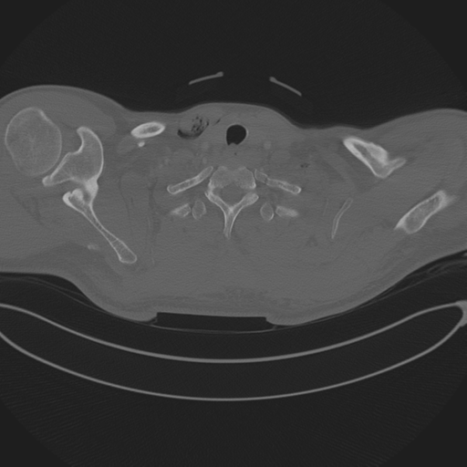Chest multitrauma - aortic injury (Radiopaedia 34708-36147 Axial bone window 11).png