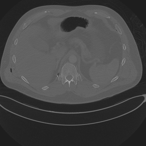 Chest multitrauma - aortic injury (Radiopaedia 34708-36147 Axial bone window 289).png