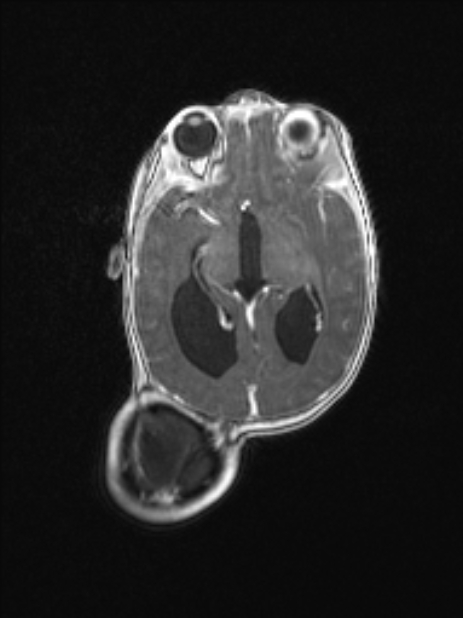 Chiari III malformation with occipital encephalocele (Radiopaedia 79446-92559 Axial T1 C+ mpr 47).jpg