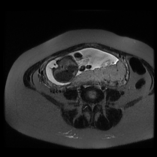 Chiari II malformation - fetal MRI (Radiopaedia 68099-77581 Axial T2-SSFSE 23).jpg