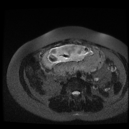 Chiari II malformation - fetal MRI (Radiopaedia 68099-77581 Axial T2-SSFSE 3).jpg