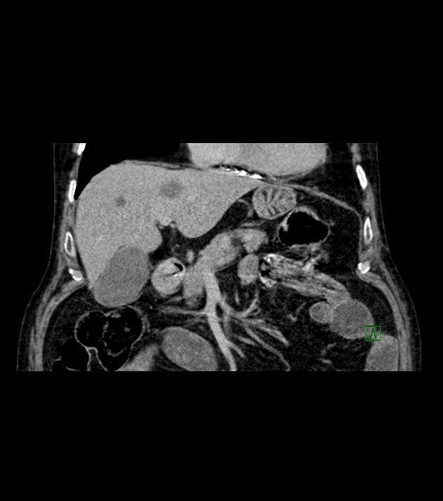 Cholangiocarcinoma with cerebral metastases (Radiopaedia 83519-98629 Coronal C+ delayed 31).jpg