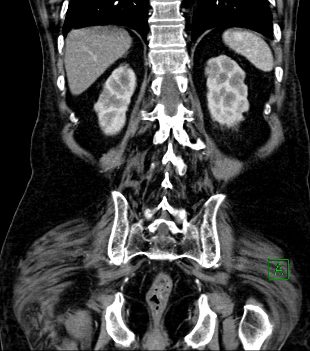 Cholangiocarcinoma with cerebral metastases (Radiopaedia 83519-98629 E 67).jpg