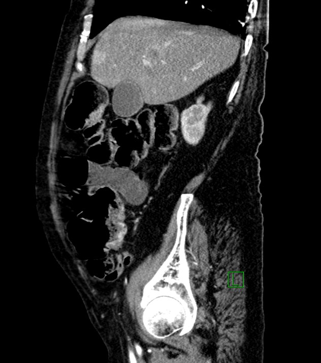 Cholangiocarcinoma with cerebral metastases (Radiopaedia 83519-98629 F 90).jpg